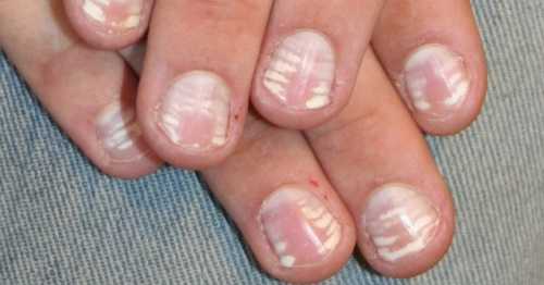Белые пятна на ногтях пальцев рук, ног
