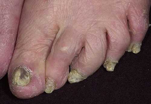 Лечение грибка ногтей на ногах, руках запущенная форма