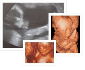 Замершую беременность можно определить на очередном осмотре гинеколога или на ультра звуковом исследовании